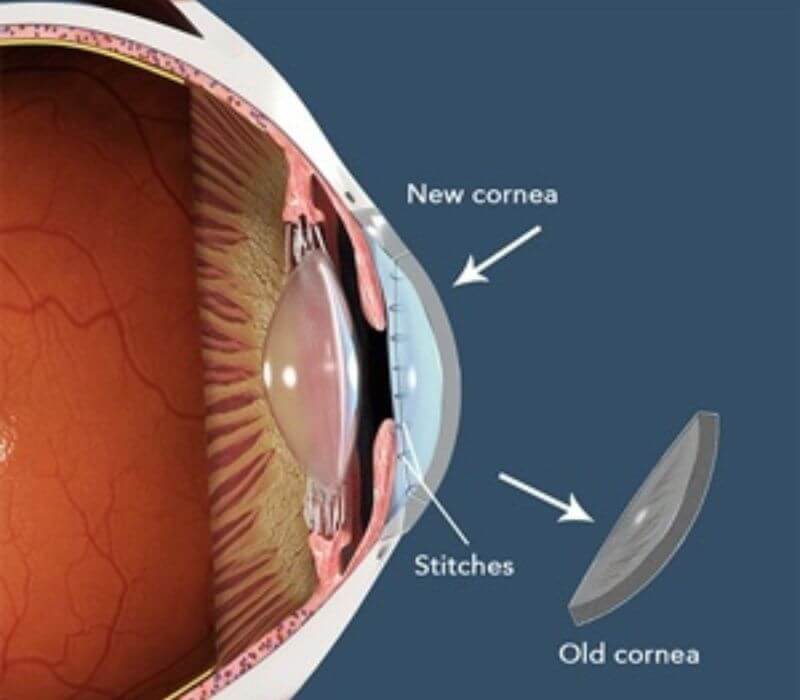 Cornea transplant surgery