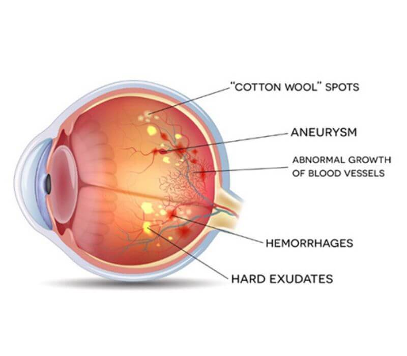 Digital angiography for Diabetic retinopathy management