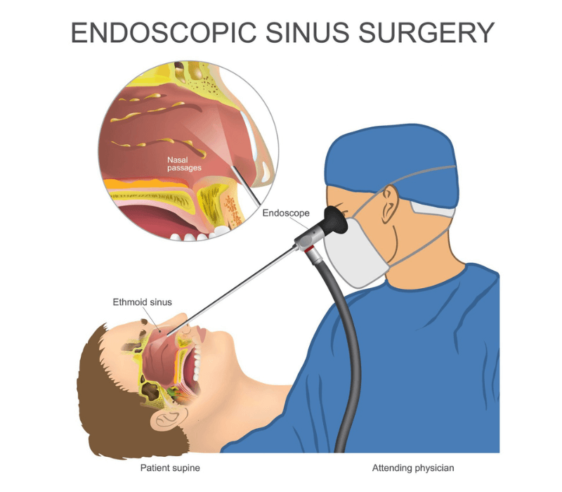 Endoscopy Sinus Surgery (FESS)