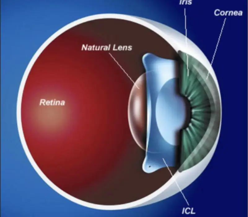 ICL-Implantable contact lens 