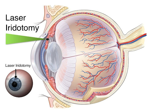 Lenssectomy/ yag laser for afteriridotomy 