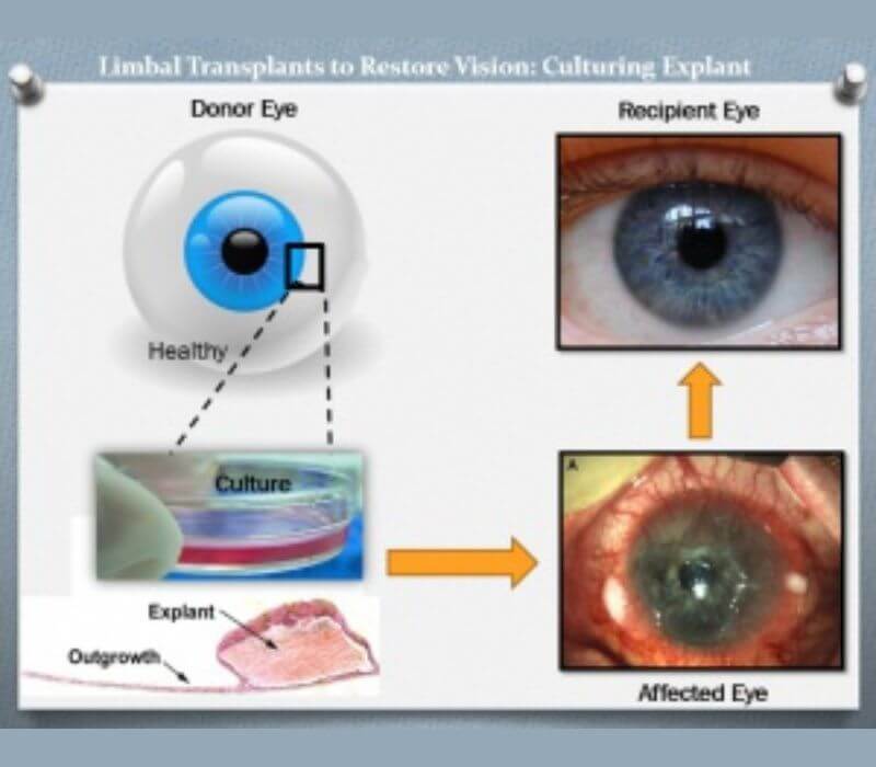 Limbal Stem Cell And Amniotic Membrane Transplant/Eye Injury/Cornea Repair  in Jalandhar | Expert Eye & ENT Care Services |  Kataria Eye and Ent Hospital Jalandhar