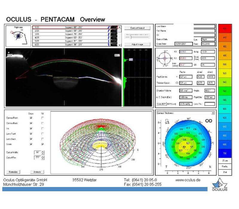 Pachymetry and Corneal Topography: Essential Tools for Assessing Eye Health |  Kataria Eye and Ent Hospital Jalandhar