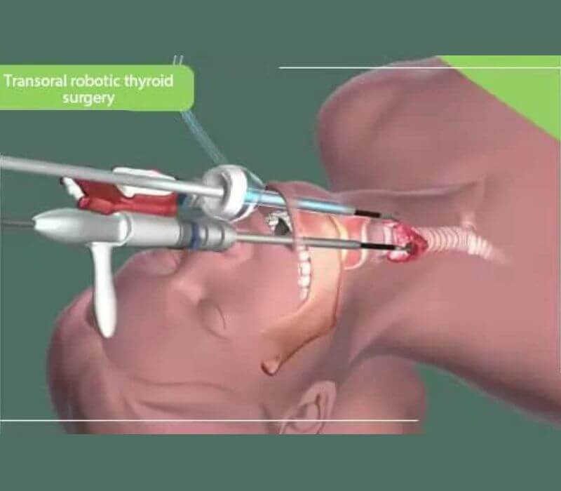 Thyroid Surgery/RND